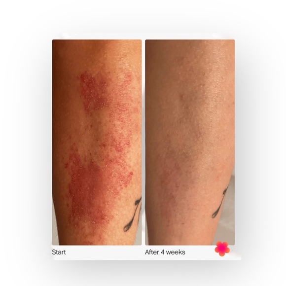 Topicals ❂ Like Butter Skin Hydrating Cream ❂ Dry Eczema Prone Skin ❂ Full Size - Picture 5 of 16